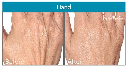 Radiesse, Before & After On Hands