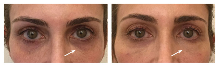 EyeRise-Before-After-Treatment-FountainOf30-Lauren