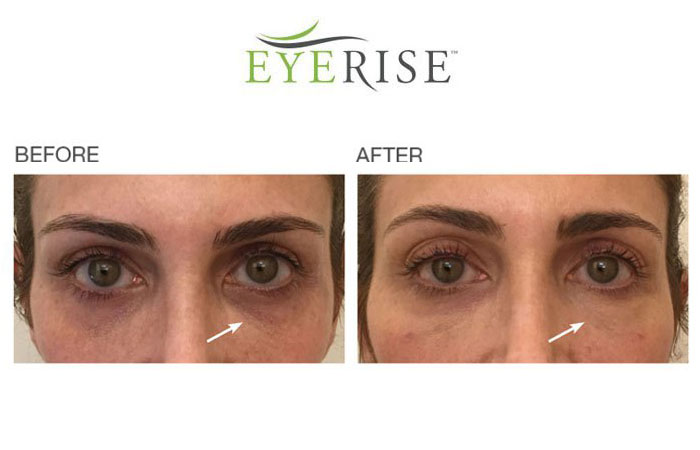 EyeRise-Undereye-Circle-treatment-Before-After
