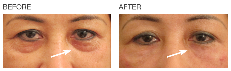 Before-After-under-eyes-EyeRise-Cosmetic-Treatment