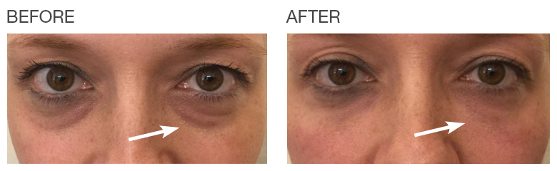 EyeRise-Undereye-circles-before-after-Patient