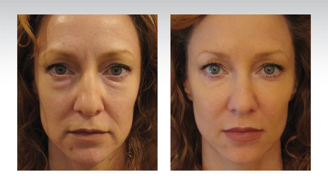 baselift-patient-before-after-redhead-face