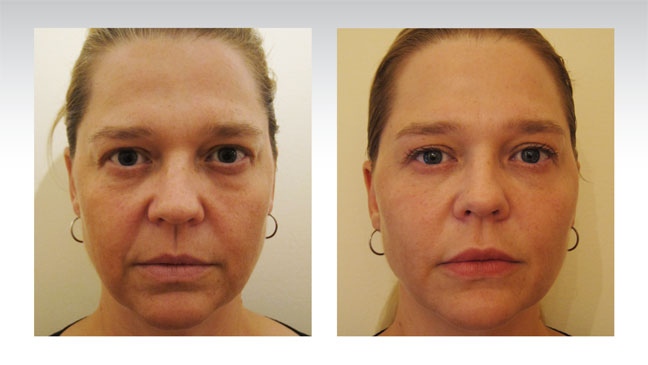 patient-before-after-baselift-face