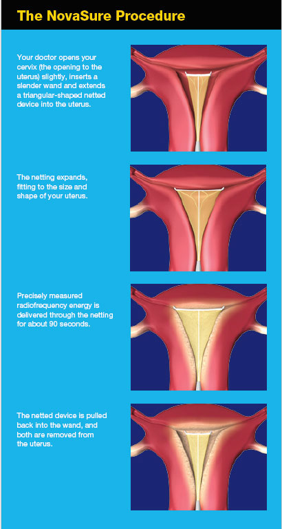 Nova-Sure-steps-Endometrial-Ablation 