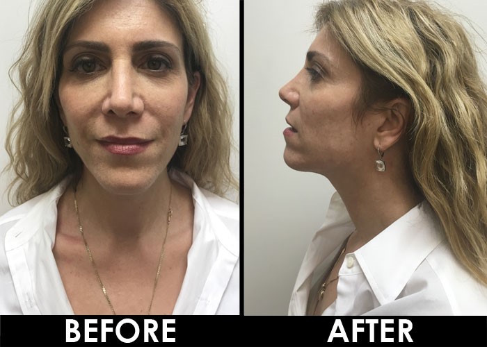 Ultherapy-before-and-after