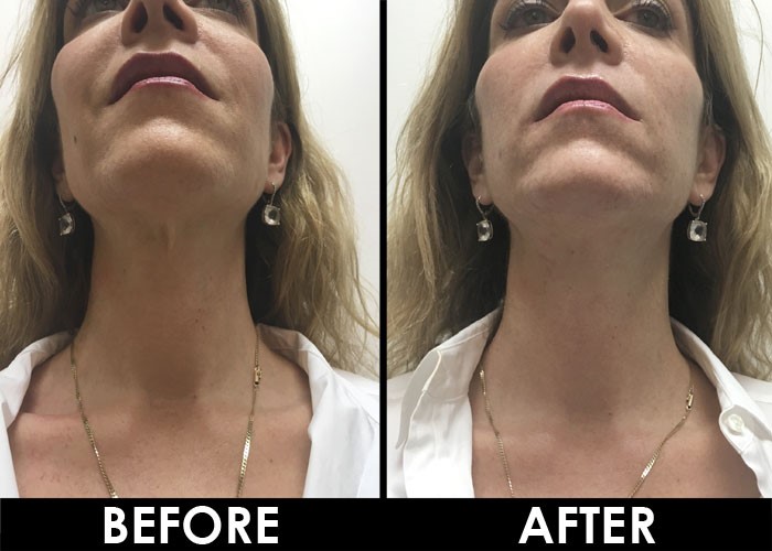 Ultherapy=before-and-after-no-turkey-neck