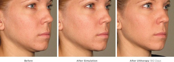 Ultherapy_before_and_after-younger-woman