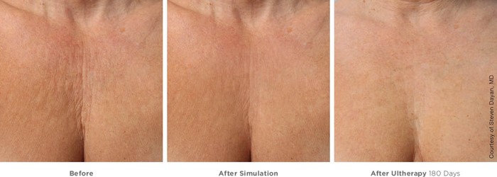 Ultherapy_before_and_after_decolletage