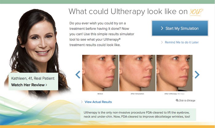 ultherapy_kathleen_before_and_after