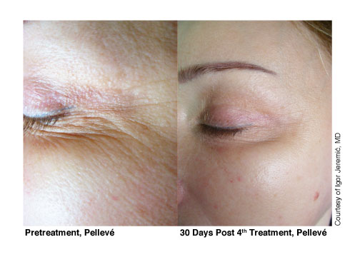 3-Pelleve-Before-&-After-Treatment-Photos