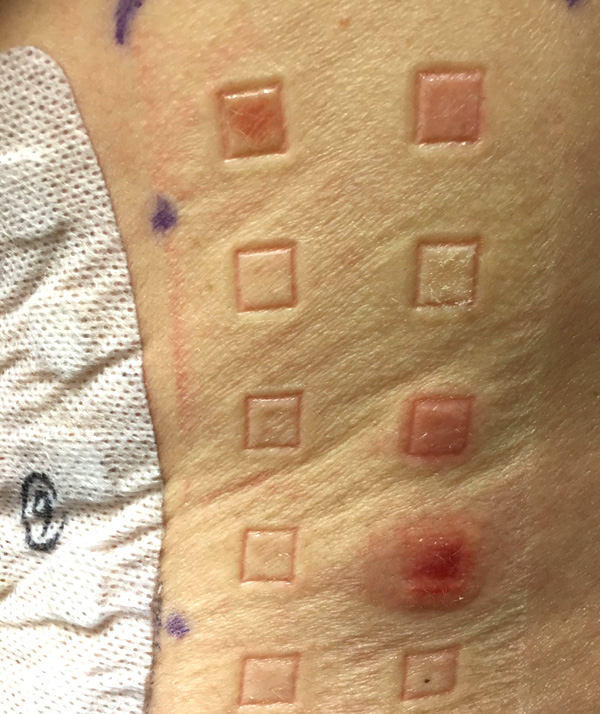skin allergy patch test