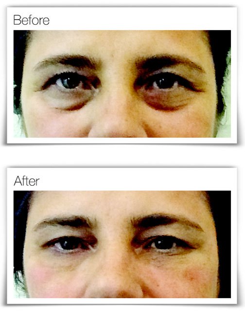 Verve Non-Surgical EyeRise before and after photos