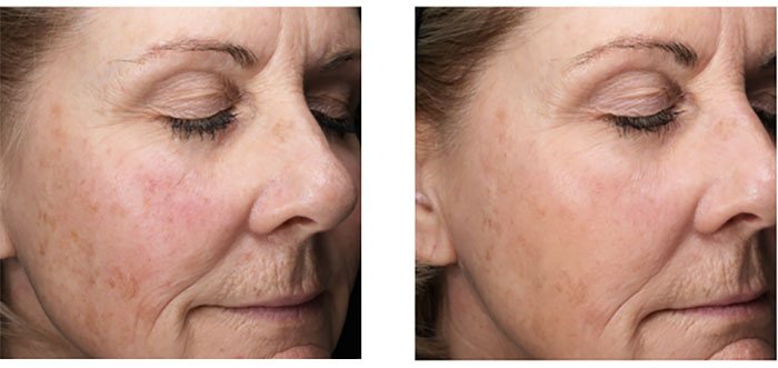 emepelle woman skin before and after photos