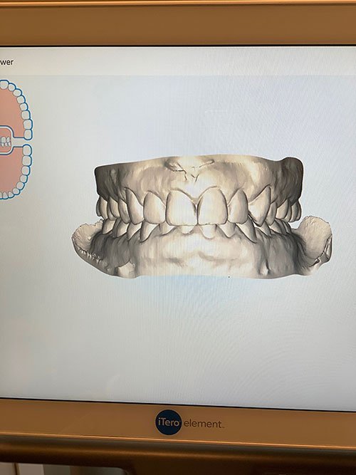 Orthodonstist 3D mold of teeth SmileDirectClub Fountain of 30 review