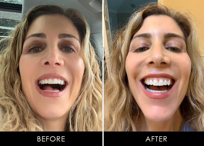 SmileDirectClub befoer and after top teeth lauren dimet waters