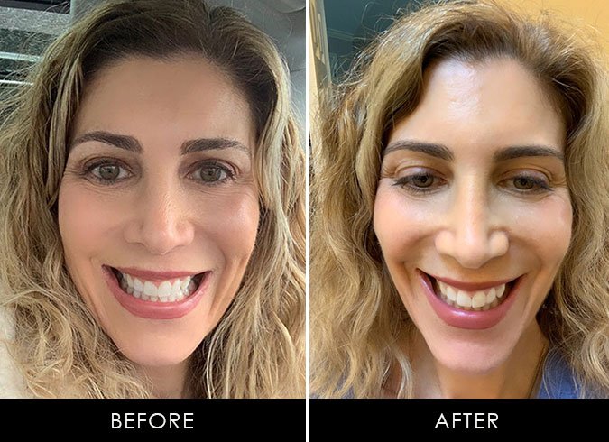 SmileDirectClub Teeth Straightening before after smile