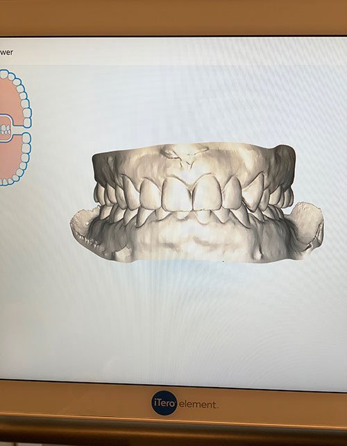 SmileDirectClub Teeth Straightening