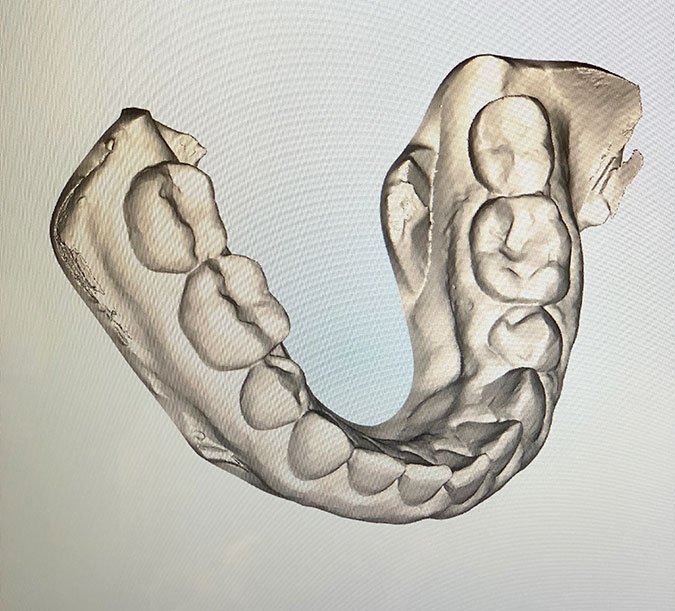 SmileDirectClub mold for aligners fountainof30