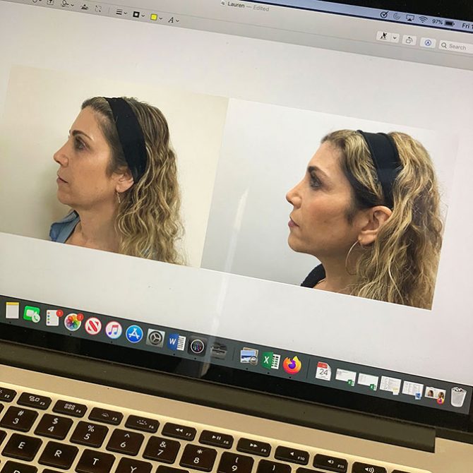 ultherapy before and after fountainof30