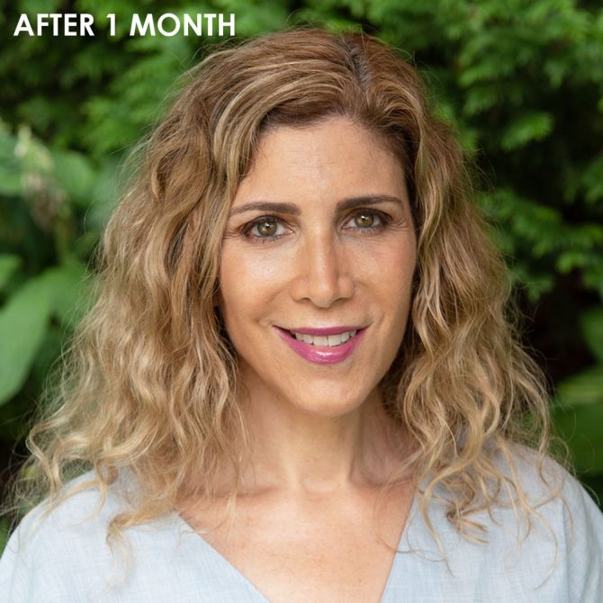 ultherapy after 1 month Lauern Dimet Waters after 1 month Lauern Dimet Waters fountainof30