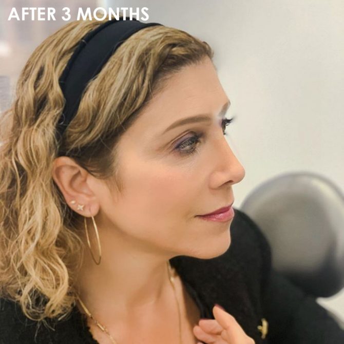 What Is Ultherapy after 3 months jawline fountainof30