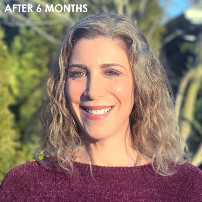 Ultherapy after 6 months after 6 months lauren Dimet Waters fountainof30
