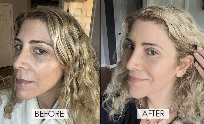 Qure Micro-Infusion Facial System before and after fountainof30