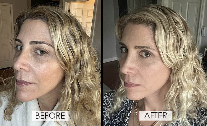 Qure Micro-Infusion facail System Lauren before and after fountainof30